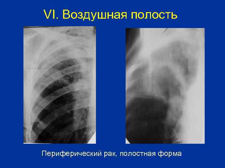 VI. Воздушная полость Периферический рак, полостная форма 