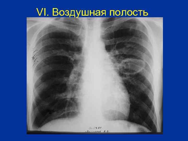 VI. Воздушная полость 