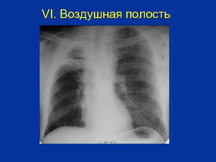 VI. Воздушная полость 