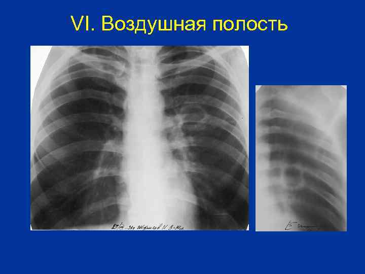 VI. Воздушная полость 