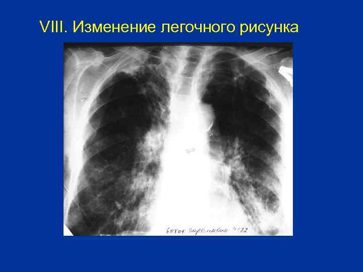 VIII. Изменение легочного рисунка 