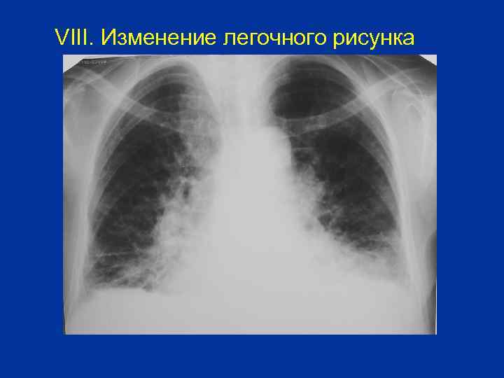 VIII. Изменение легочного рисунка 