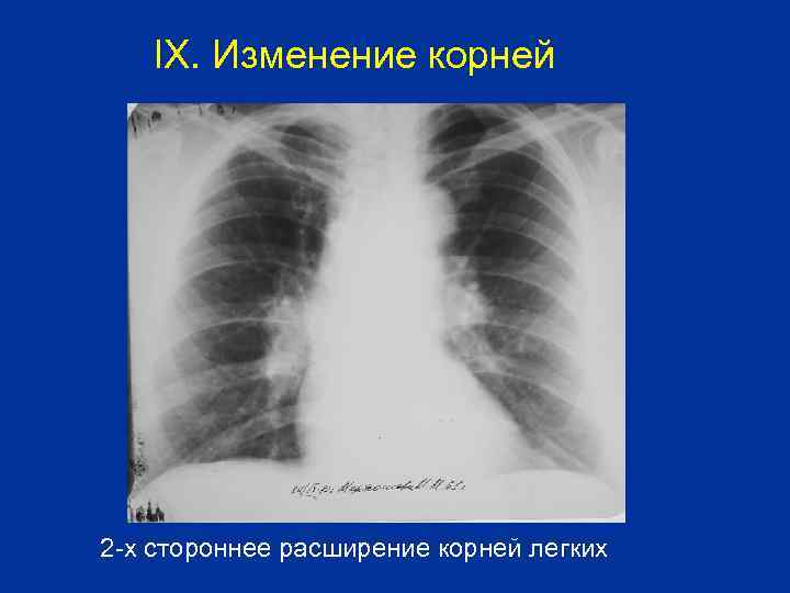 IX. Изменение корней 2 -х стороннее расширение корней легких 