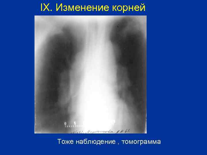 IX. Изменение корней Тоже наблюдение , томограмма 