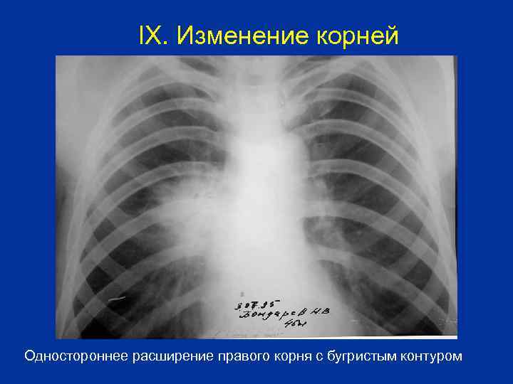 IX. Изменение корней Одностороннее расширение правого корня с бугристым контуром 