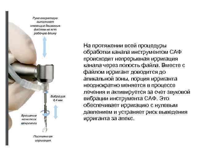 На протяжении всей процедуры обработки канала инструментом САФ происходит непрерывная ирригация канала через полость