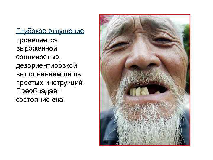 Глубокое оглушение проявляется выраженной сонливостью, дезориентировкой, выполнением лишь простых инструкций. Преобладает состояние сна. 