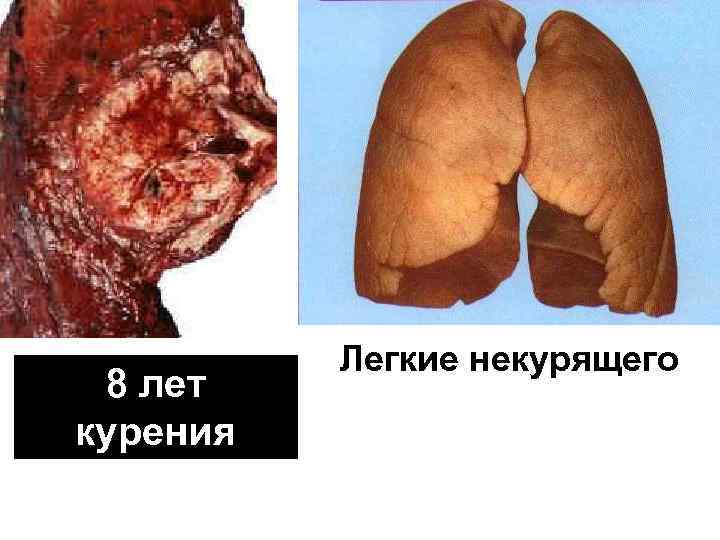 8 лет курения Легкие некурящего 