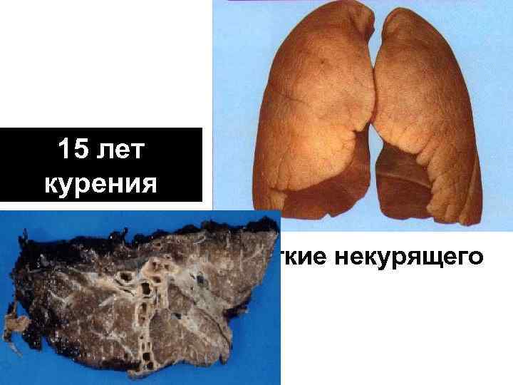 15 лет курения Легкие некурящего 