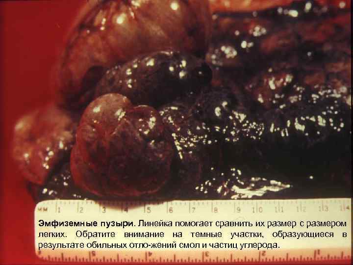 Эмфиземные пузыри. Линейка помогает сравнить их размер с размером легких. Обратите внимание на темные