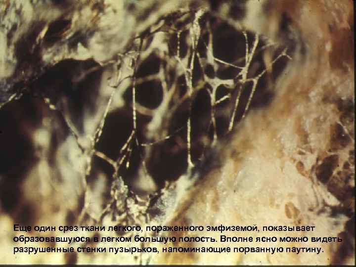 Еще один срез ткани легкого, пораженного эмфиземой, показывает образовавшуюся в легком большую полость. Вполне