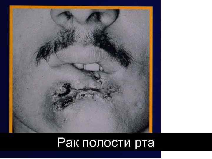 Рак полости рта 