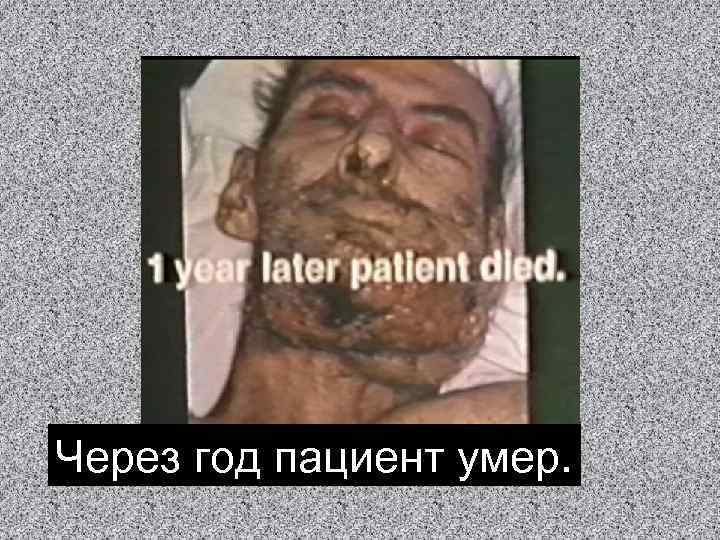 Через год пациент умер. 