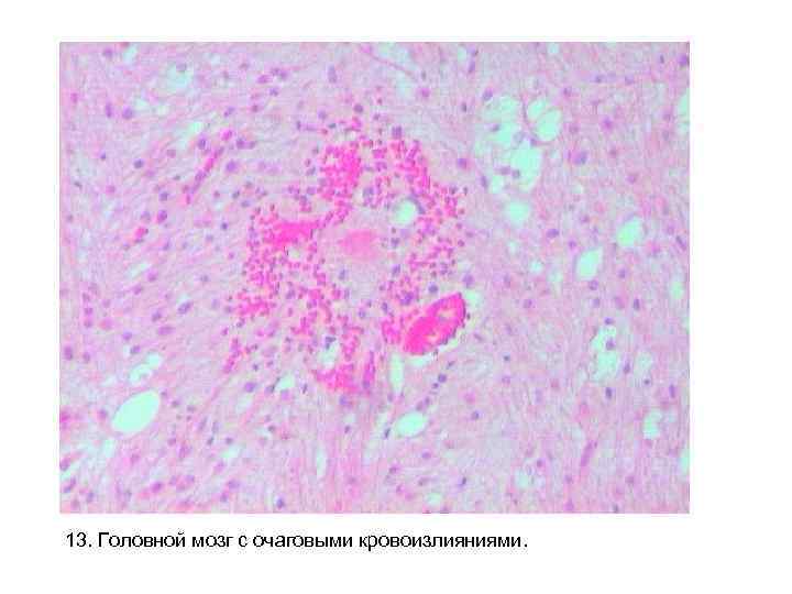 13. Головной мозг с очаговыми кровоизлияниями. 