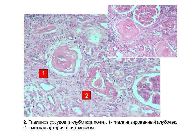 1 2 2. Гиалиноз сосудов и клубочков почки. 1 - гиалинизированный клубочек, 2 –