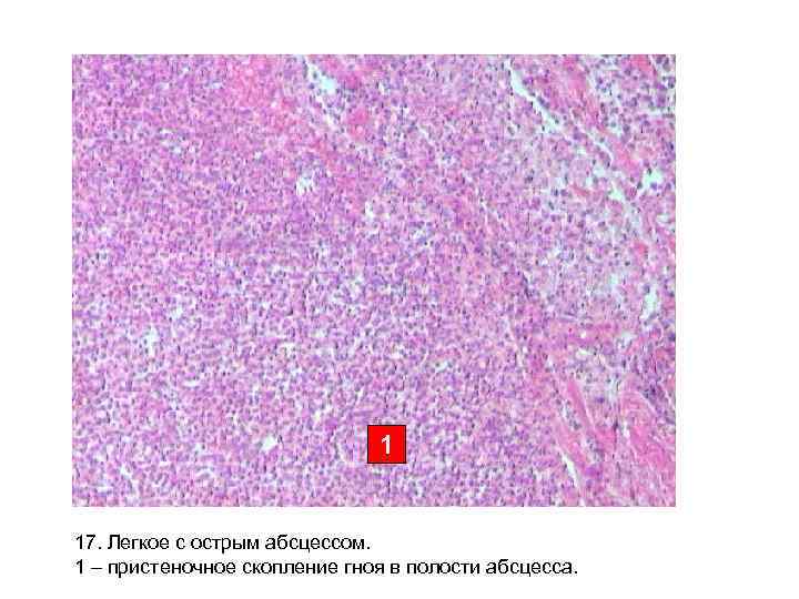 1 17. Легкое с острым абсцессом. 1 – пристеночное скопление гноя в полости абсцесса.