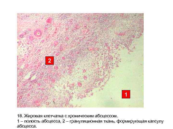 2 1 18. Жировая клетчатка с хроническим абсцессом. 1 – полость абсцесса, 2 –