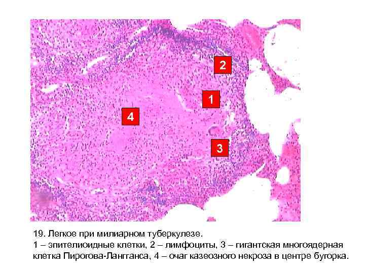 2 1 4 3 19. Легкое при милиарном туберкулезе. 1 – эпителиоидные клетки, 2