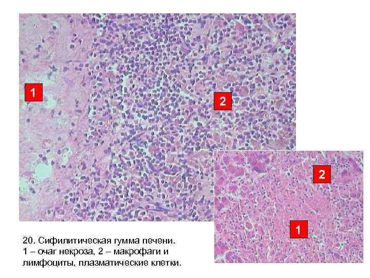 1 2 2 20. Сифилитическая гумма печени. 1 – очаг некроза, 2 – макрофаги