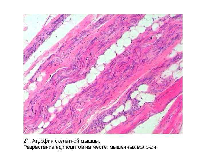 21. Атрофия скелетной мышцы. Разрастание адипоцитов на месте мышечных волокон. 
