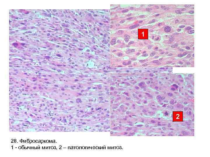 1 2 28. Фибросаркома. 1 - обычный митоз, 2 – патологический митоз. 
