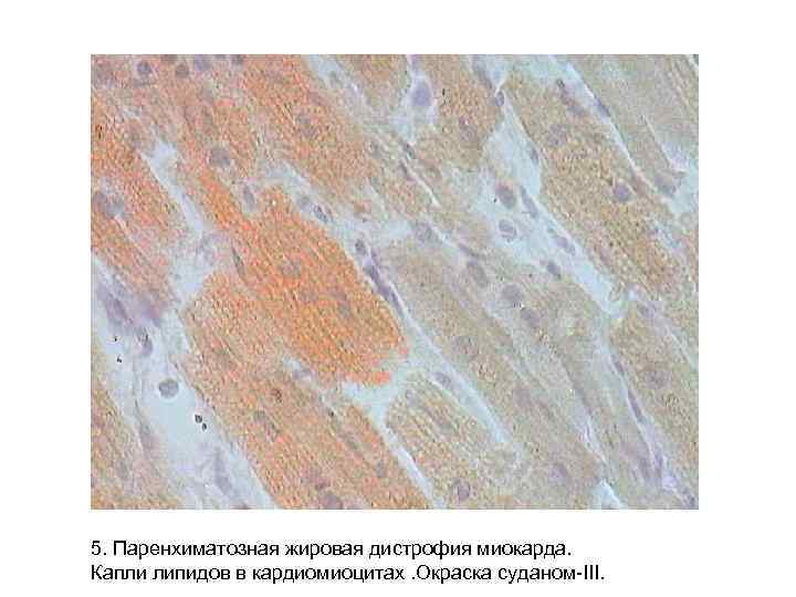 5. Паренхиматозная жировая дистрофия миокарда. Капли липидов в кардиомиоцитах. Окраска суданом-III. 