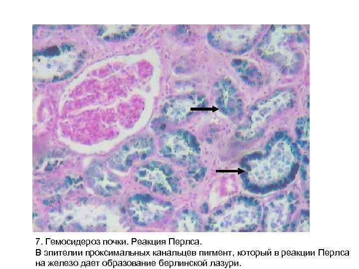 7. Гемосидероз почки. Реакция Перлса. В эпителии проксимальных канальцев пигмент, который в реакции Перлса