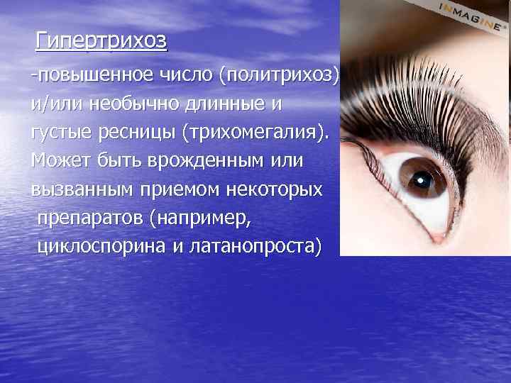 Гипертрихоз -повышенное число (политрихоз) и/или необычно длинные и густые ресницы (трихомегалия). Может быть врожденным