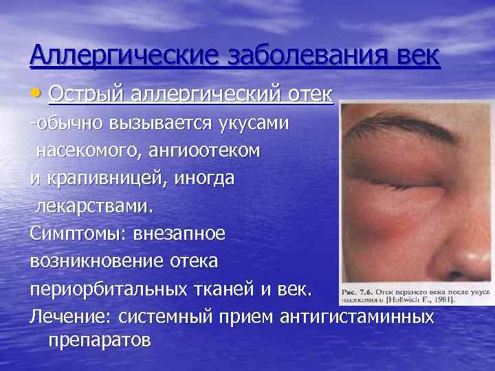 Аллергические заболевания век • Острый аллергический отек -обычно вызывается укусами насекомого, ангиоотеком и крапивницей,