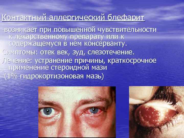 Контактный аллергический блефарит -возникает при повышенной чувствительности к лекарственному препарату или к содержащемуся в