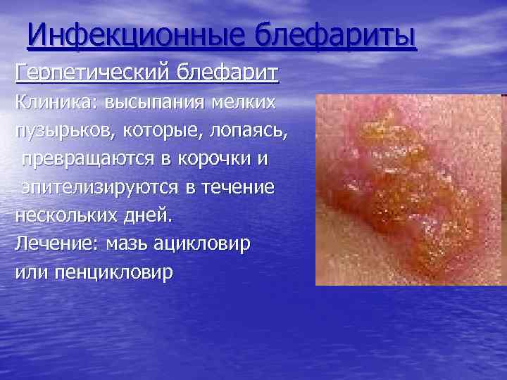 Инфекционные блефариты Герпетический блефарит Клиника: высыпания мелких пузырьков, которые, лопаясь, превращаются в корочки и