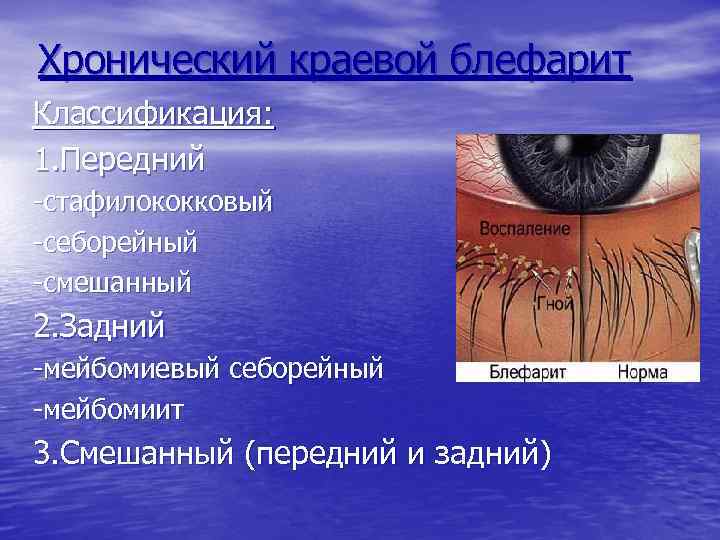 Хронический краевой блефарит Классификация: 1. Передний -стафилококковый -себорейный -смешанный 2. Задний -мейбомиевый себорейный -мейбомиит