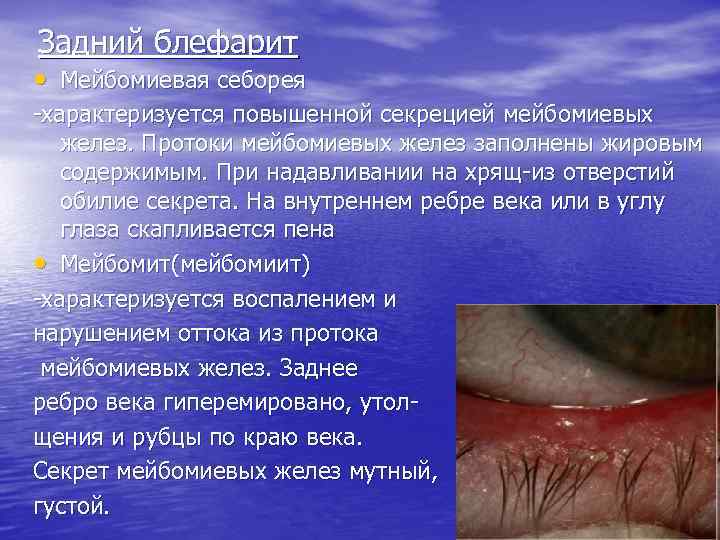 Задний блефарит • Мейбомиевая себорея -характеризуется повышенной секрецией мейбомиевых желез. Протоки мейбомиевых желез заполнены