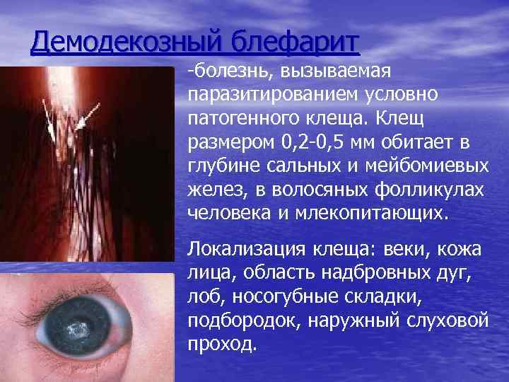 Демодекозный блефарит -болезнь, вызываемая паразитированием условно патогенного клеща. Клещ размером 0, 2 -0, 5