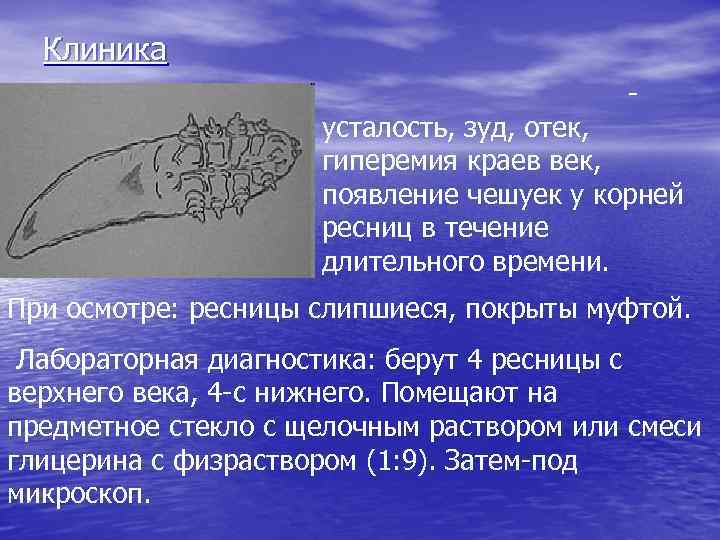 Клиника - усталость, зуд, отек, гиперемия краев век, появление чешуек у корней ресниц в