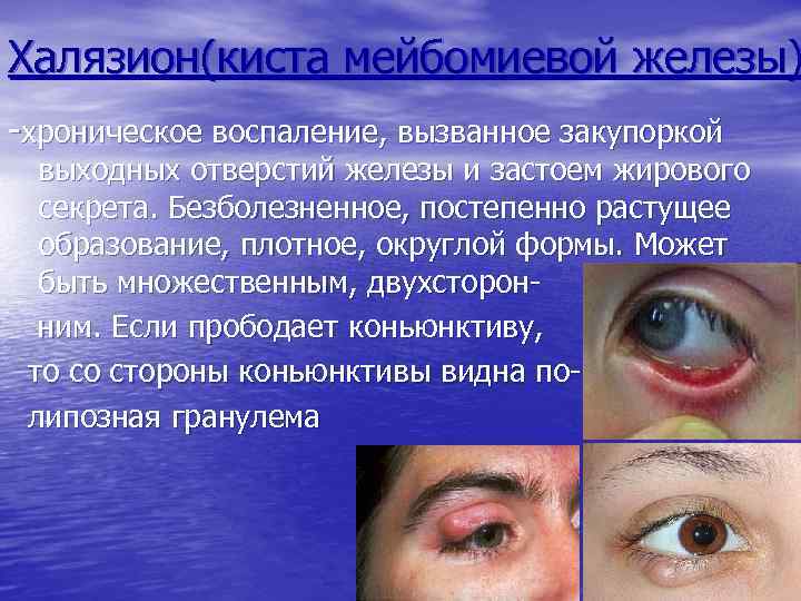 Халязион(киста мейбомиевой железы) -хроническое воспаление, вызванное закупоркой выходных отверстий железы и застоем жирового секрета.