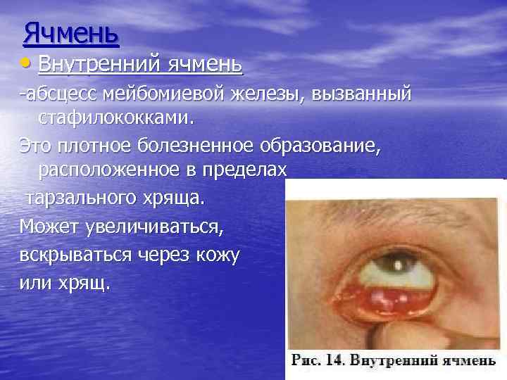 Ячмень • Внутренний ячмень -абсцесс мейбомиевой железы, вызванный стафилококками. Это плотное болезненное образование, расположенное