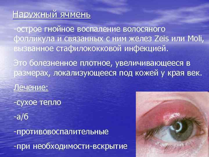 Наружный ячмень -острое гнойное воспаление волосяного фолликула и связанных с ним желез Zeis или