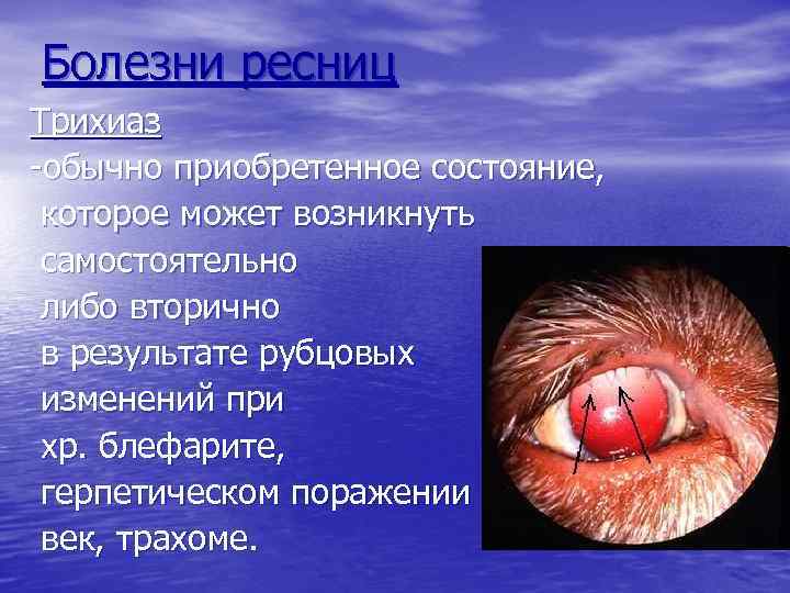 Болезни ресниц Трихиаз -обычно приобретенное состояние, которое может возникнуть самостоятельно либо вторично в результате