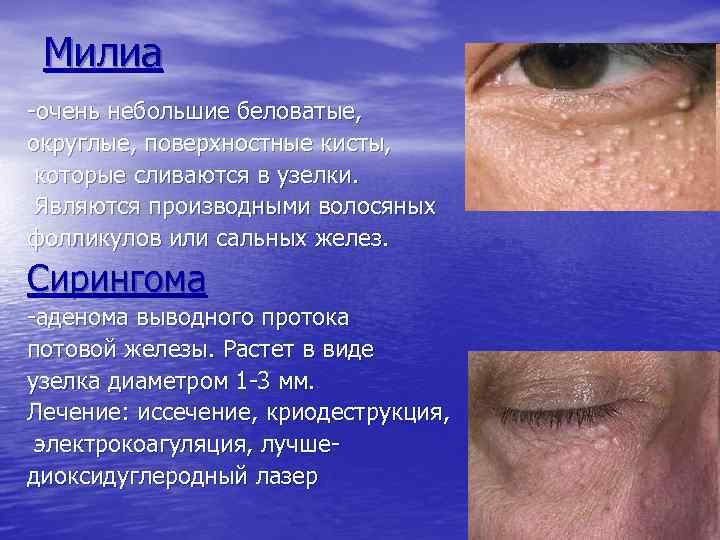 Милиа -очень небольшие беловатые, округлые, поверхностные кисты, которые сливаются в узелки. Являются производными волосяных