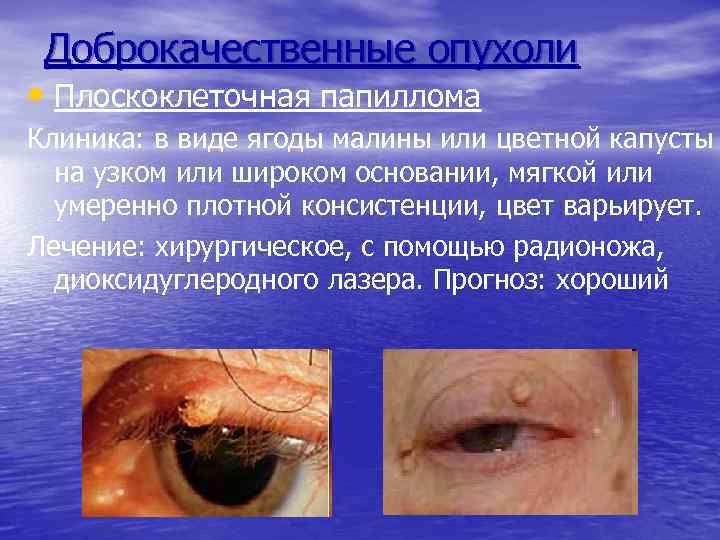 Доброкачественные опухоли • Плоскоклеточная папиллома Клиника: в виде ягоды малины или цветной капусты на