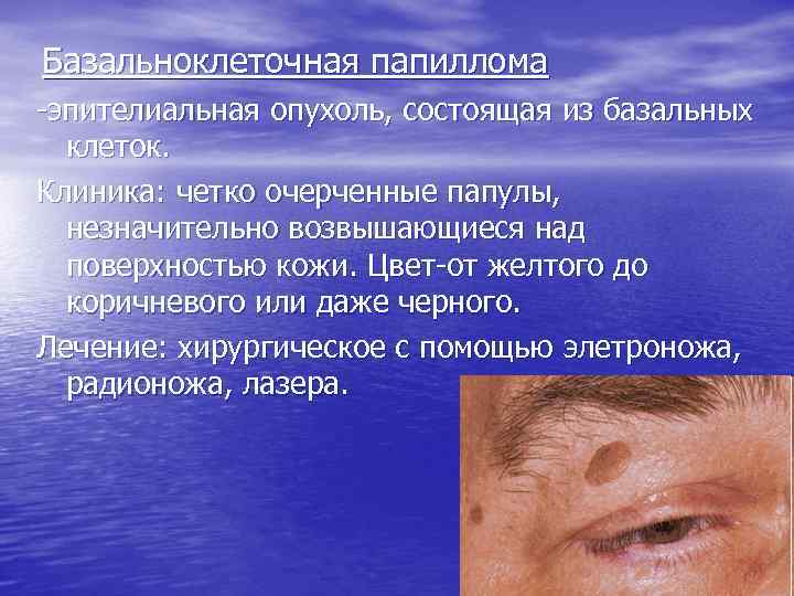 Базальноклеточная папиллома -эпителиальная опухоль, состоящая из базальных клеток. Клиника: четко очерченные папулы, незначительно возвышающиеся
