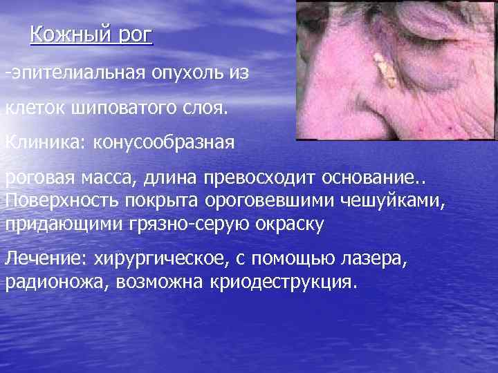 Кожный рог -эпителиальная опухоль из клеток шиповатого слоя. Клиника: конусообразная роговая масса, длина превосходит