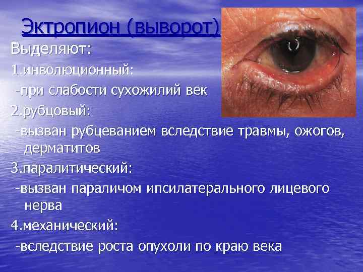 Эктропион (выворот) Выделяют: 1. инволюционный: -при слабости сухожилий век 2. рубцовый: -вызван рубцеванием вследствие