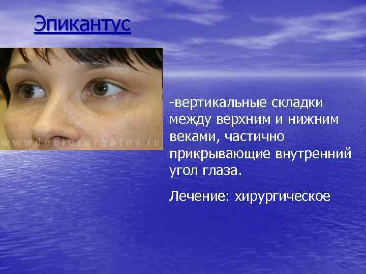 Эпикантус -вертикальные складки между верхним и нижним веками, частично прикрывающие внутренний угол глаза. Лечение: