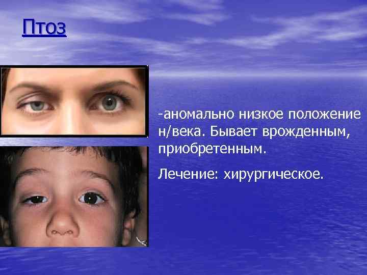 Птоз -аномально низкое положение н/века. Бывает врожденным, приобретенным. Лечение: хирургическое. 