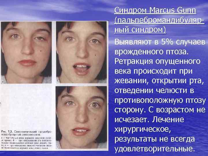Синдром Marcus Gunn (пальпебромандибулярный синдром) Выявляют в 5% случаев врожденного птоза. Ретракция опущенного века