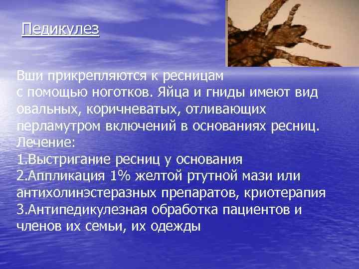 Педикулез Вши прикрепляются к ресницам с помощью ноготков. Яйца и гниды имеют вид овальных,
