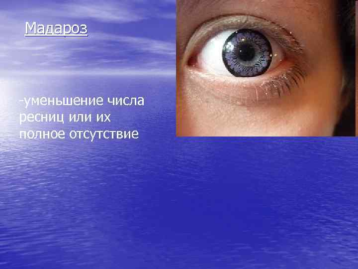Мадароз -уменьшение числа ресниц или их полное отсутствие 