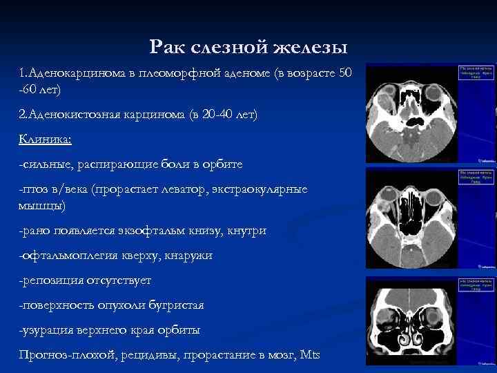 Фото аденокарцинома мейбомиевой железы